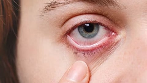 नाशिककरांनो काळजी घ्या, शहरात ‘आयफ्लू’ची साथ