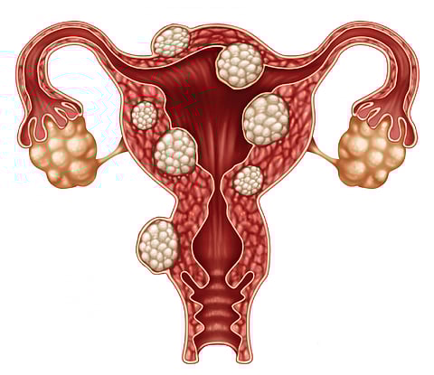 वाढतेय फायब्रॉईडस्ची समस्या! वेळीच डॉक्टरांचा सल्ला घेणे गरजेचे