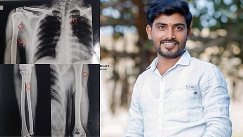 Maratha reservation | मराठा आंदोलनावेळी पोलिसांच्या फायरिंगमध्ये तरुणाच्या शरीरात घुसले ११ छर्रे