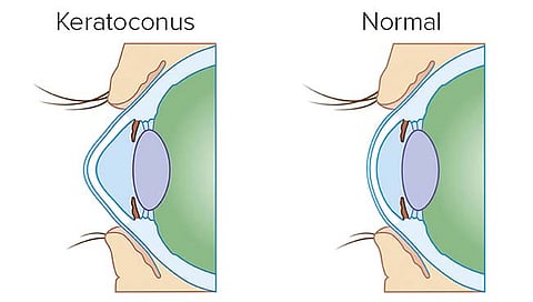 डोळ्यांचा नंबर सारखा बदलतोय, जाणून घ्या ‘केराटोकोनस’ व्याधीविषयी आणि त्यावरील उपचार