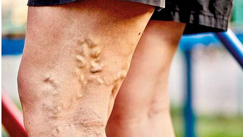 व्हेरिकोज व्हेन्सचा त्रास होण्यामागे कारणे कोणती? जाणून घ्या