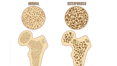 अस्थिक्षयाने त्रस्त आहात?