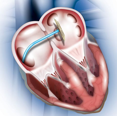 Blessing : नवजात बालकावर दुर्मीळ डिव्हाइस क्लोजर प्रक्रिया यशस्वी