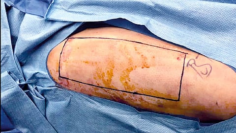 त्वचादानामुळे मिळणार अनेकांना जीवदान!