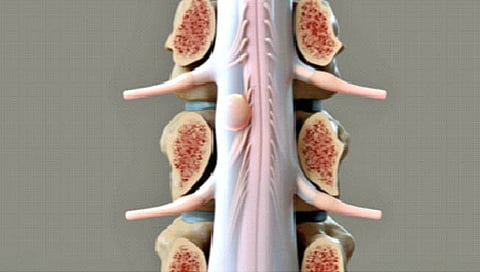 Spinal Tumor : स्पायनल ट्युमरपासून बचाव कसा कराल?
