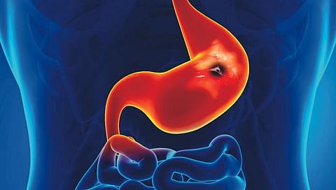 पेप्टिक अल्सर म्‍हणजे काय?, लक्षणे आणि उपचार