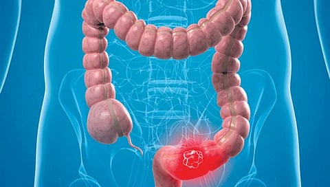 मोठ्या आतड्याचा कॅन्सर : लक्षणे आणि उपचार