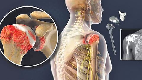 एका ठराविक वयातच खांदा का सटकतो? जाणून घ्या यामागील कारण