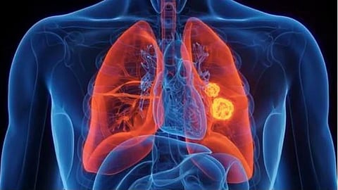 Lung Cancer Awareness