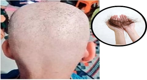 टक्‍कल साथ! शेगाव तालुक्यात तीन दिवसात पडतेय टक्‍कल