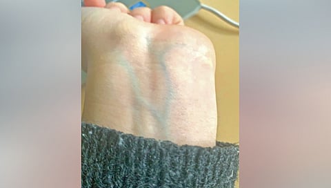 why-veins-look-blue-if-blood-is-red