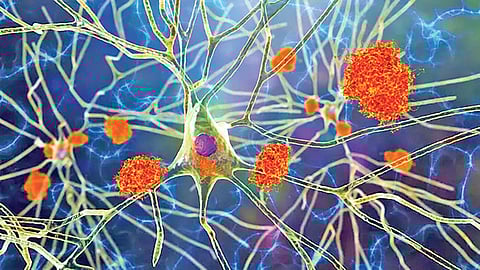 Blood test now available to diagnose Alzheimer's