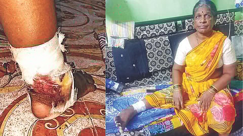 Stray dog attacks Chembur