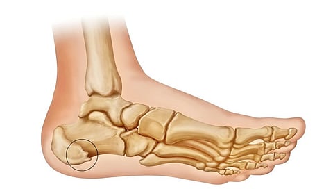 painful heel pain causes treatment remedies
