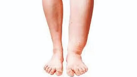 Lymphatic Filariasis