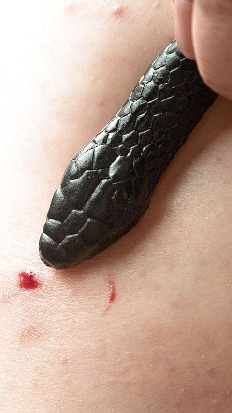 snake bite