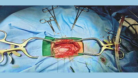 Spinal Tumor Surgery Success 