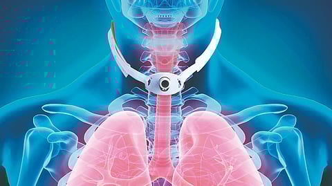 Tracheostomy Procedure