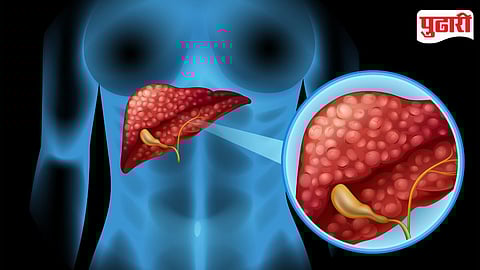 Liver disease due to Addiction