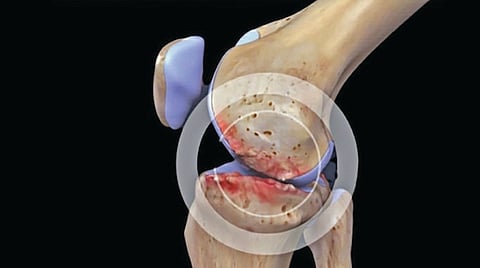 knee pain without surgery