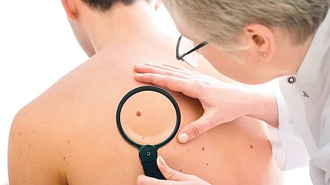 skin mole warning sign