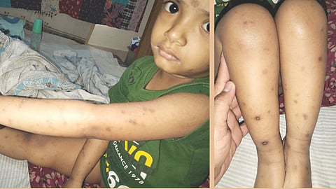 Mosquito bite causes severe injury