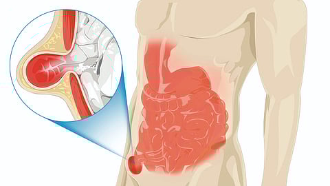 Hernia Surgery Importance |