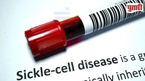 Sickle Cell