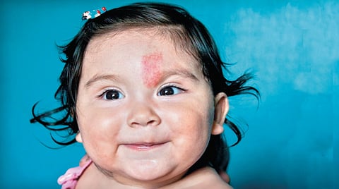 Skin birthmark science | 