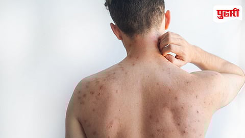 Measles Outbreak Mumbai