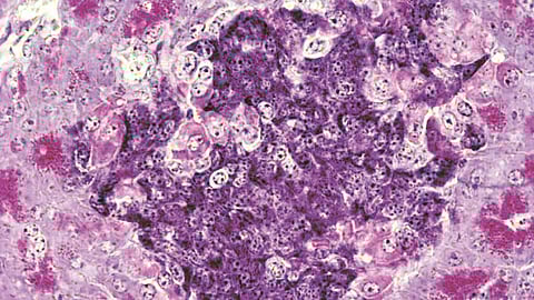 Type 1 Diabetes treatment | 