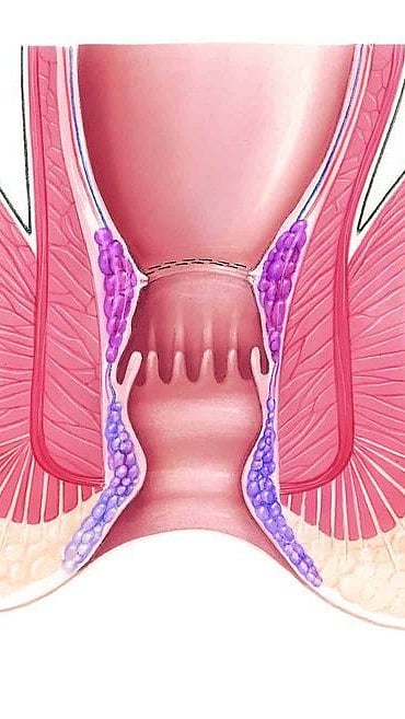 मूळव्याध होण्याची कारणे काय?