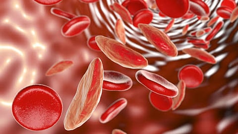 Sickle Cell Disease