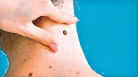 Skin tags  |