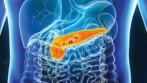 Pancreatic cancer treatment |
