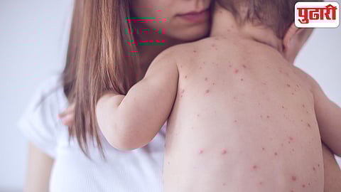 Bangladesh Measles