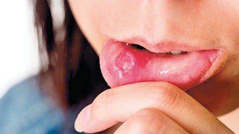 Mouth ulcers causes | 