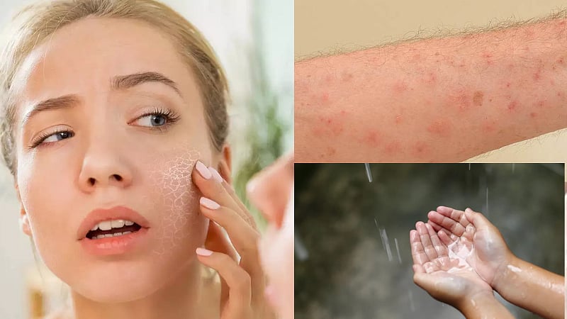 Health tips | மழைக்காலத்தில் ஏற்படும் சரும பிரச்னைகள் என்னென்ன? தடுக்க என்ன வழிகள்?/common skin problems during rainly season