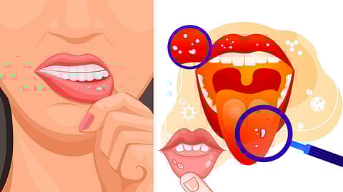 வாய்ப்புண்