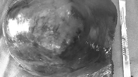 திருச்சி:  1.5 கிலோ புற்றுநோய் கட்டி -  வெற்றிகரமாக அகற்றிய அரசு மருத்துவர்கள் Trichy: Govt doctors successfully removed 1.5 kg cancerous tumor