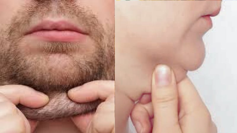 இரட்டை கன்னம் பிரச்னையிலிருந்து விடுபடுவது எப்படி/How to Get Rid of a Double Chin explained by doctor