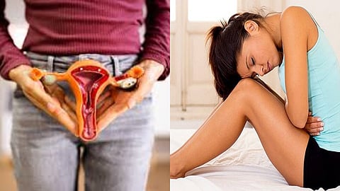 vulvodynia