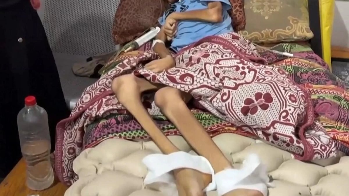 GAZA|3 நாட்களில் ஊட்டச்சத்து குறைபாடு மற்றும் பட்டினியால் 21 குழந்தைகள் இறப்பு!