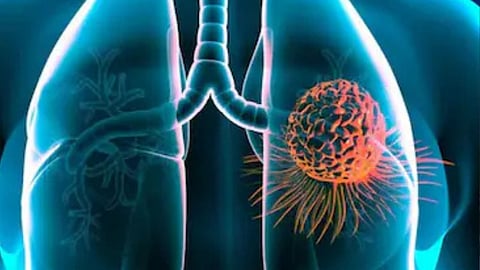 lung cancer