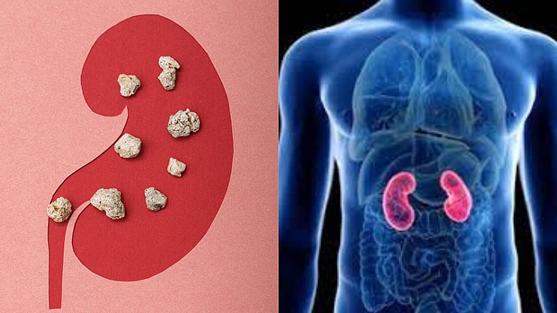12% இந்தியர்களுக்கு சிறுநீரகக் கல் பிரச்னை... தவிர்க்க வேண்டிய உணவுகள் என்னென்ன?
