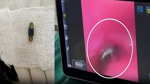 விசிலை விழுங்கிய 5 வயது குழந்தையை காப்பாற்றிய எழும்பூர் அரசு மருத்துவர்கள்