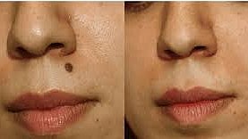 மச்சத்தை சுயமாக அகற்றுவதால் ஆபத்து.. மருத்துவர்கள் எச்சரிக்கை!  