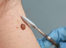 DIY mole removal is dangerous 