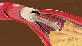 Laser angioplasty is not beneficial for patients with heart conditions