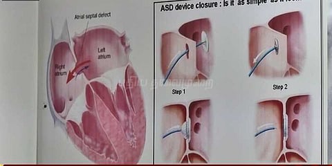 இருதய நோயை தடுக்கும் யோகா
